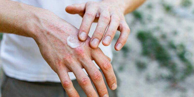 applying an emollient to dry flaky skin as in the treatment of psoriasis, eczema and other dry skin conditions. White cream on skin