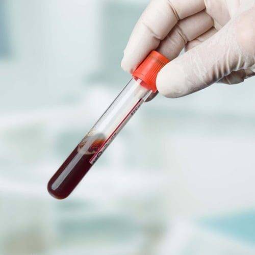 Blood Sample For Allergy Test